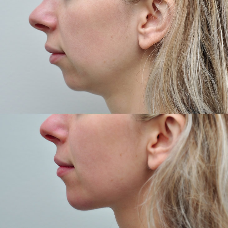 Chin Augmenation